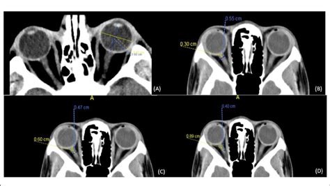 optic nerve thickness measurement radiology|normal optic nerve sheath diameter.